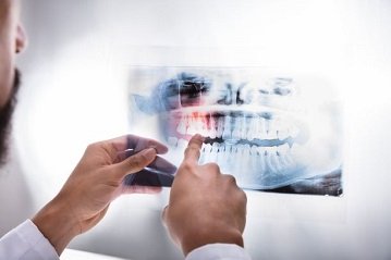 10 X rays