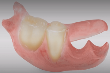 19 Removable partial dentures