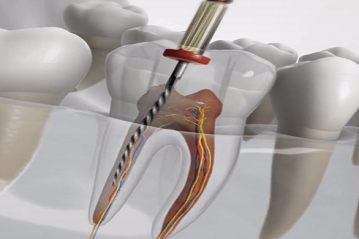 20 Root Canal Treatment